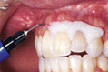Bělení zubů ordinační - nanášení gingivální bariéry