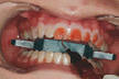 Bělení zubů ordinační - bělící gel na zubech
