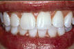 Bělení zubů ordinační - stav po bělení