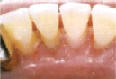 Dentální hygiena - po odstranění zubního kamene