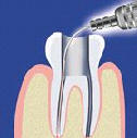 Ošetření kořenových kanálků laserem (endodoncie)