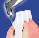 Ošetření dásní a sliznic laserem (parodontologie)