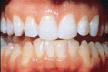 Bělení zubů domácí - vybělené zuby