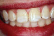 Bělení zubů ordinační - stav před bělením