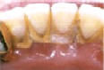 Dentální hygiena - odstranění zubního kamene