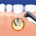 Stomatochirurgie s využitím zubního laseru
