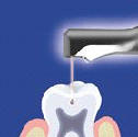 Ošetření zubních kazů laserem (záchovná stomatologie)