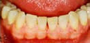 Pískování zubů - stav po