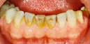 Pískování zubů - stav před