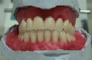Zubní protézy - snímatelné náhrady